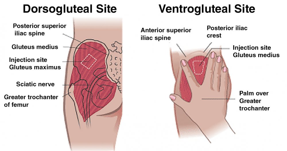 Ventrogluteal-and-Dorsogluteal-IM-Injection-Site.thumb.jpg.8aec7c1a0d6e0466ad420565232105dc.jpg